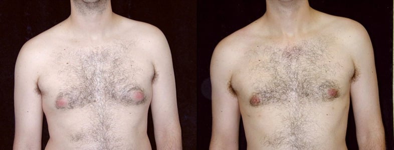 Gynecomastia Patient 1 Before & After