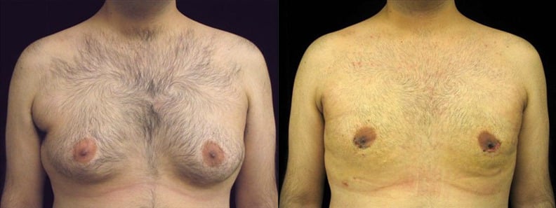 Gynecomastia Patient 8 Before & After