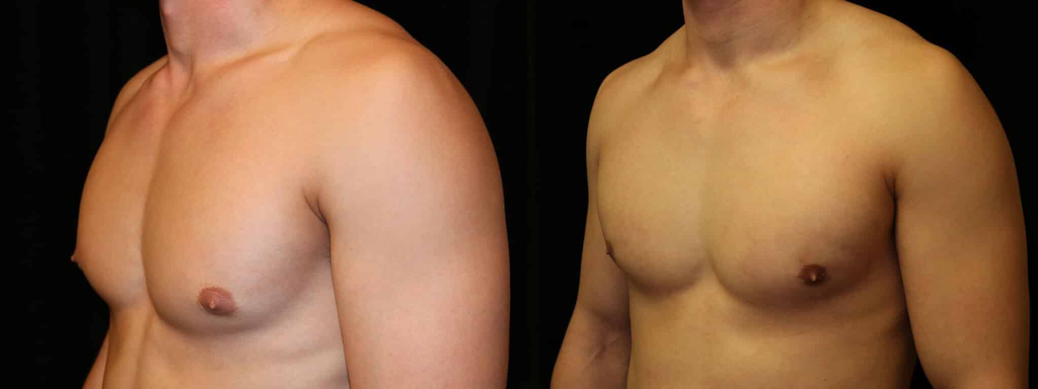 Gynecomastia Patient 14 Before & After Details