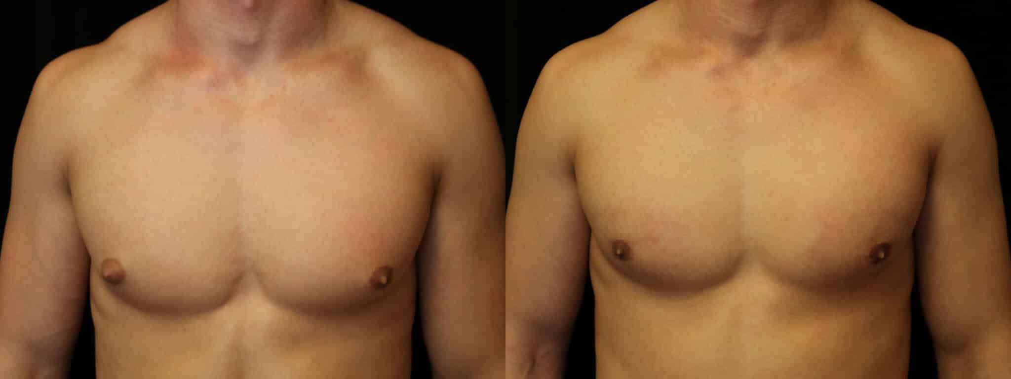 Gynecomastia Patient 14 Before & After