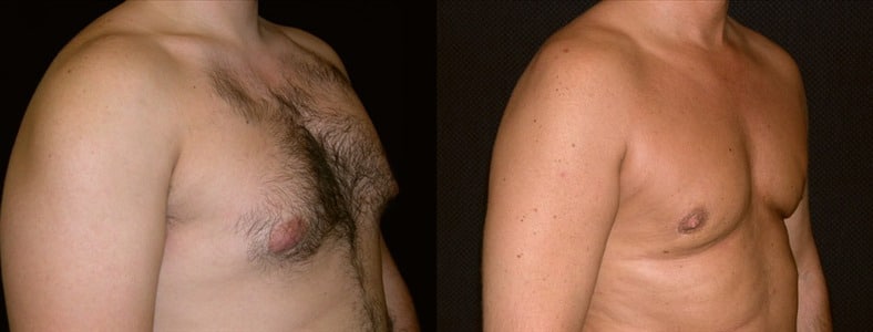 Gynecomastia Patient 18 Before & After