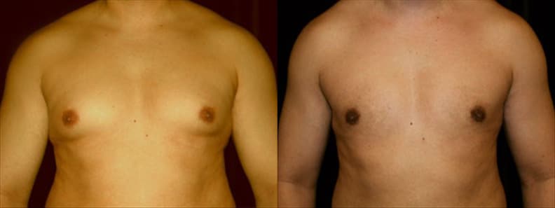 Gynecomastia Patient 10 Before & After