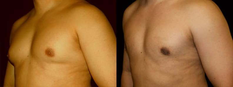 Gynecomastia Patient 10 Before & After Details