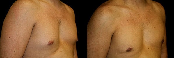 Gynecomastia Patient 20 Before & After Details