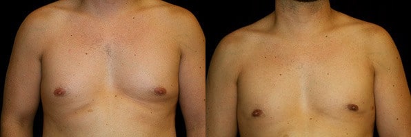 Gynecomastia Patient 20 Before & After