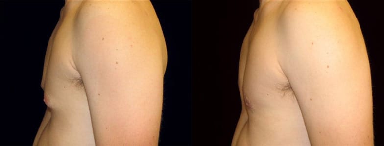 Gynecomastia Patient 12 Before & After