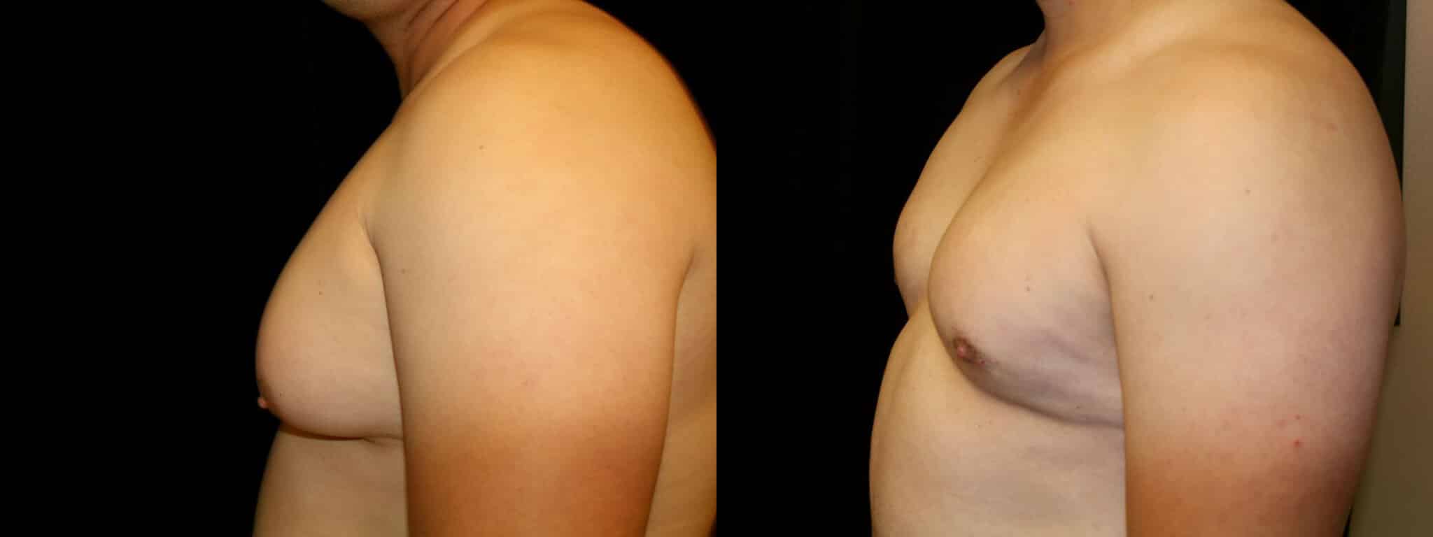 Gynecomastia Patient 13 Before & After Details