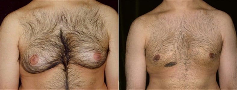 Gynecomastia Patient 2 Before & After