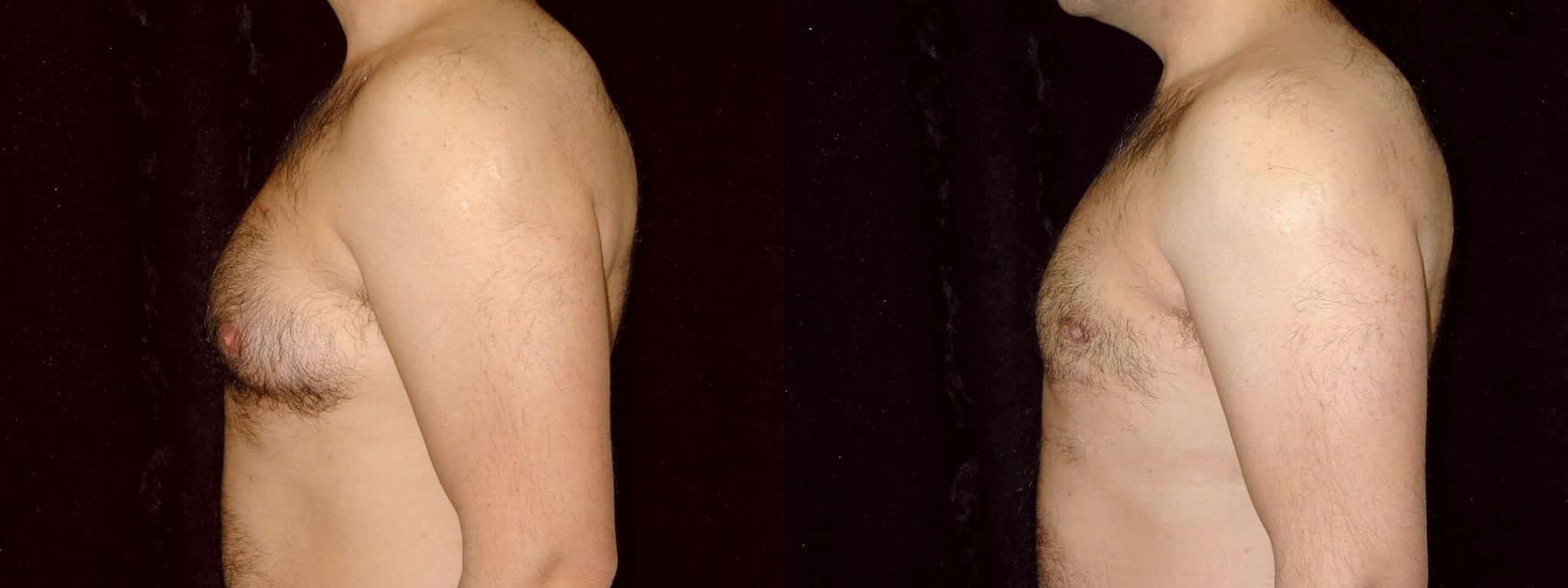 Gynecomastia Patient 4 Before & After Details