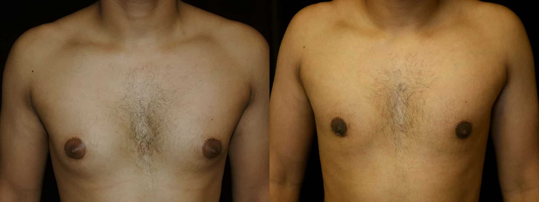 Gynecomastia Patient 15 Before & After