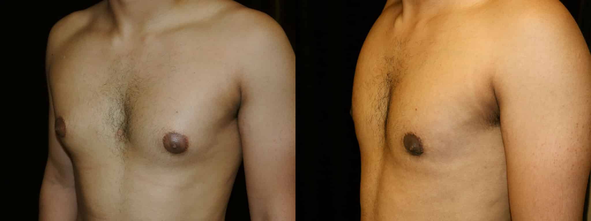 Gynecomastia Patient 15 Before & After Details