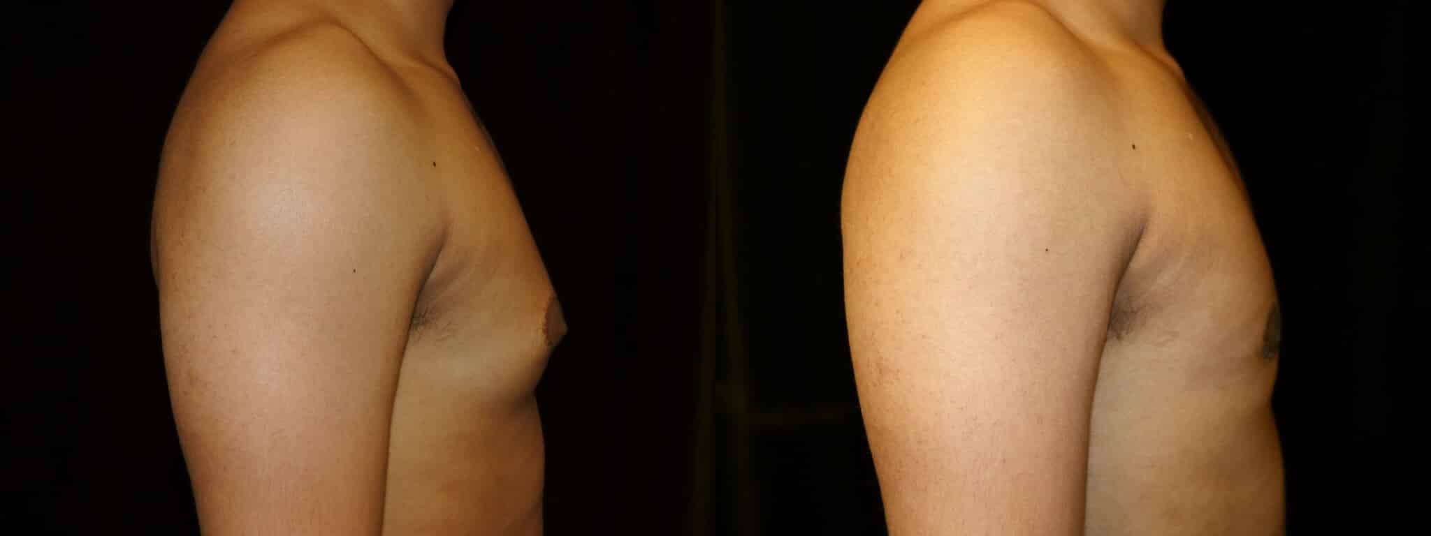 Gynecomastia Patient 15 Before & After Details