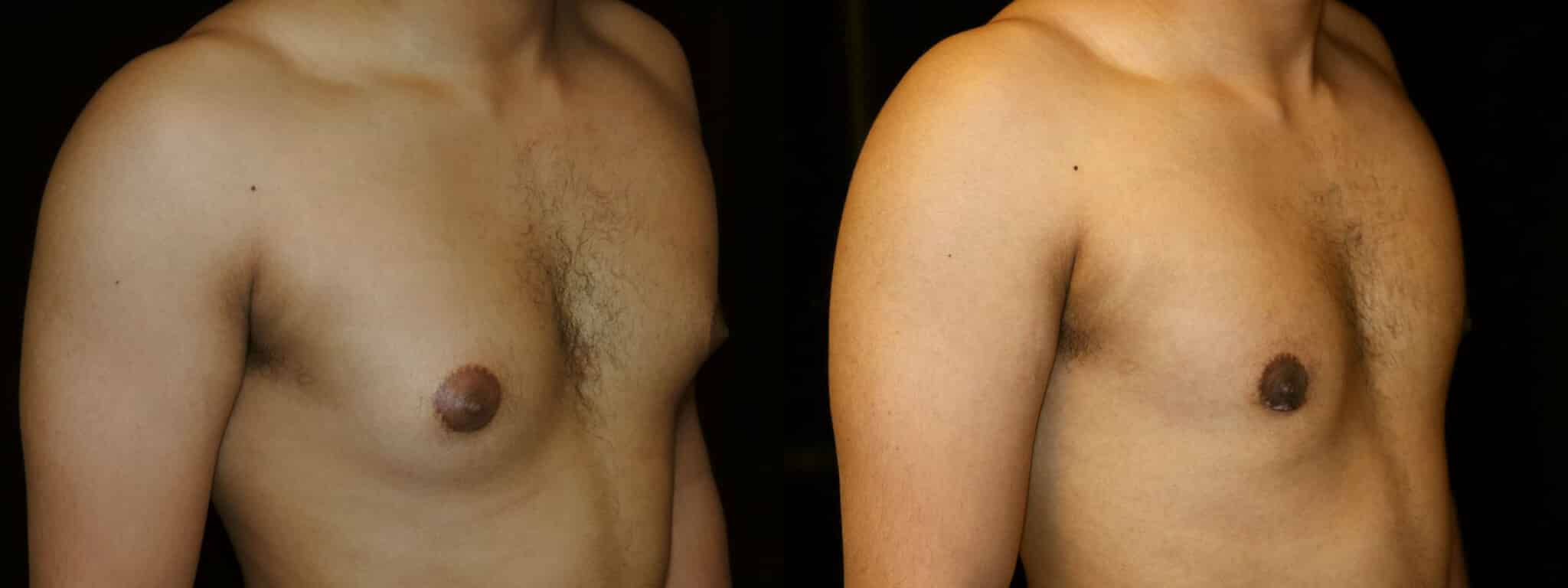 Gynecomastia Patient 15 Before & After Details