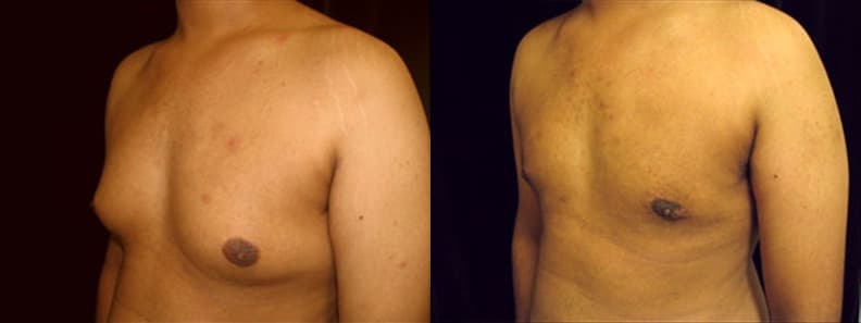 Gynecomastia Patient 1 Before & After Details