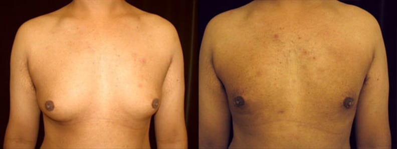 Gynecomastia Patient 1 Before & After