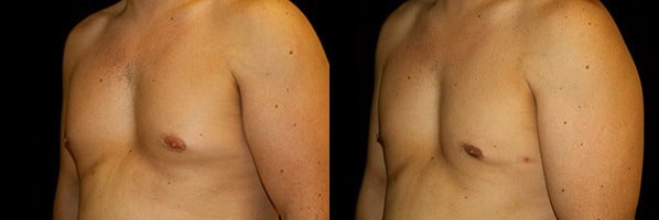 Gynecomastia Patient 20 Before & After Details