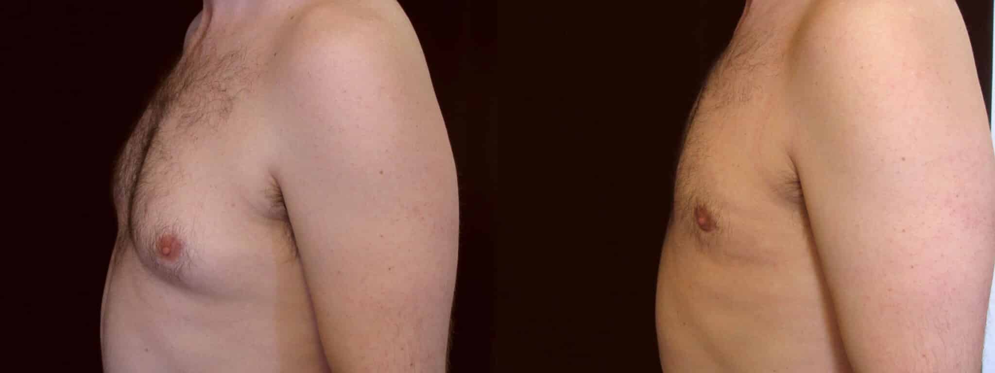 Gynecomastia Patient 15 Before & After Details