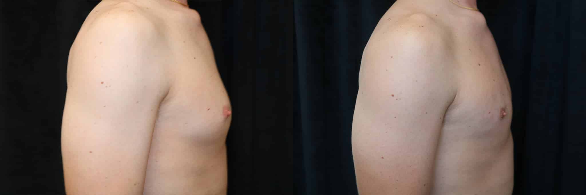 Gynecomastia Patient 17 Before & After Details