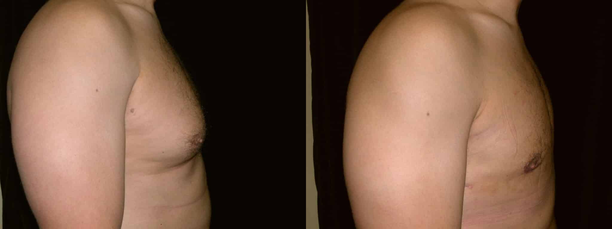 Gynecomastia Patient 9 Before & After Details