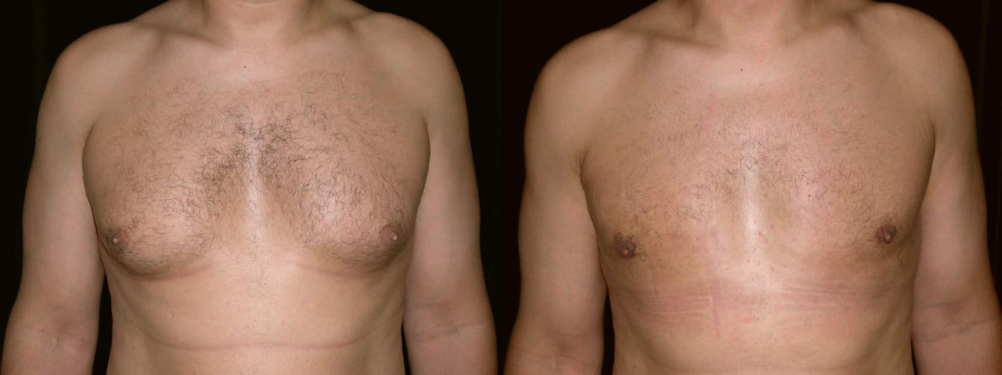 Gynecomastia Patient 9 Before & After
