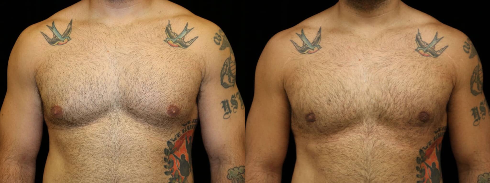 Gynecomastia Patient 6 Before & After