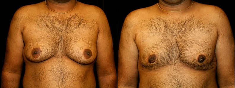 Gynecomastia Patient 20 Before & After