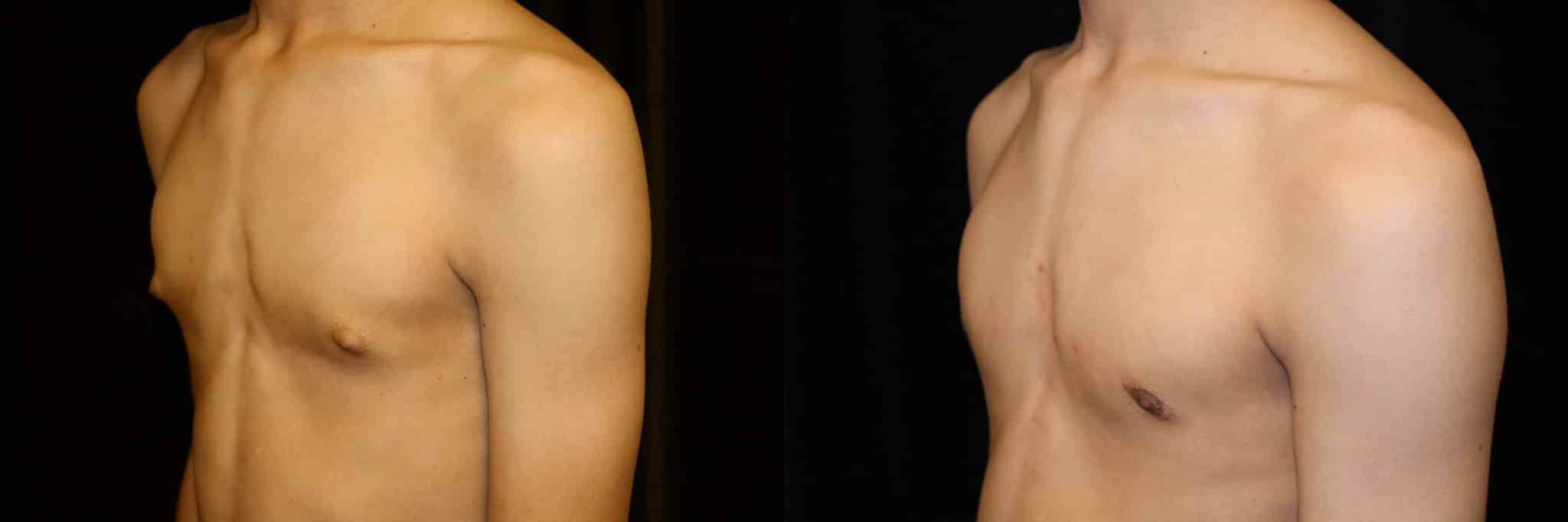 Gynecomastia Patient 3 Before & After Details