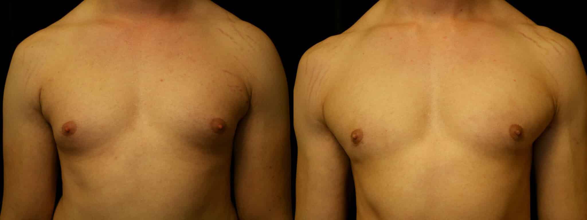 Gynecomastia Patient 15 Before & After