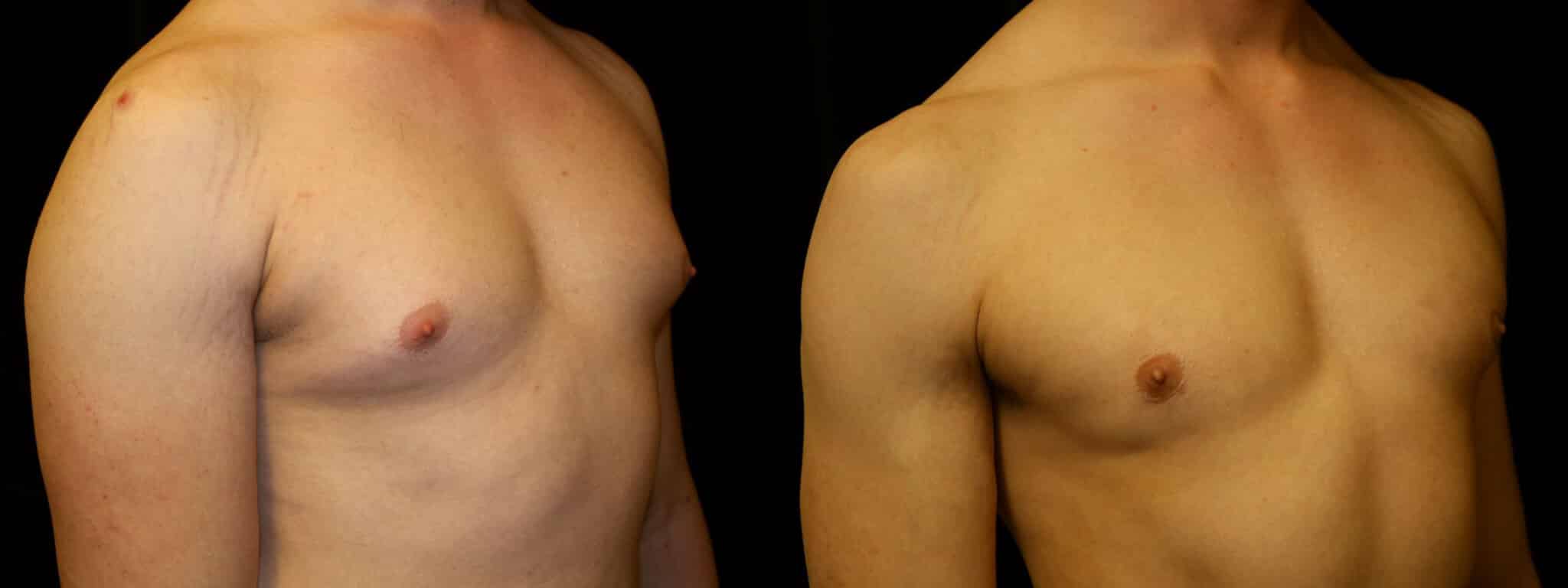 Gynecomastia Patient 15 Before & After Details