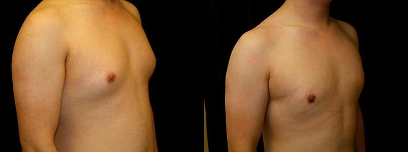 Gynecomastia Patient 19 Before & After Details