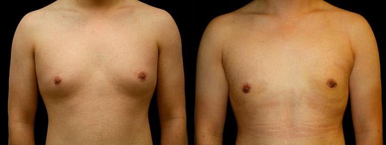 Gynecomastia Patient 19 Before & After