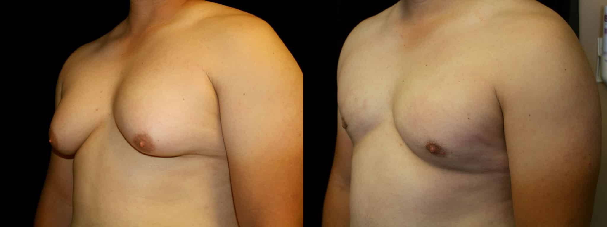 Gynecomastia Patient 13 Before & After Details