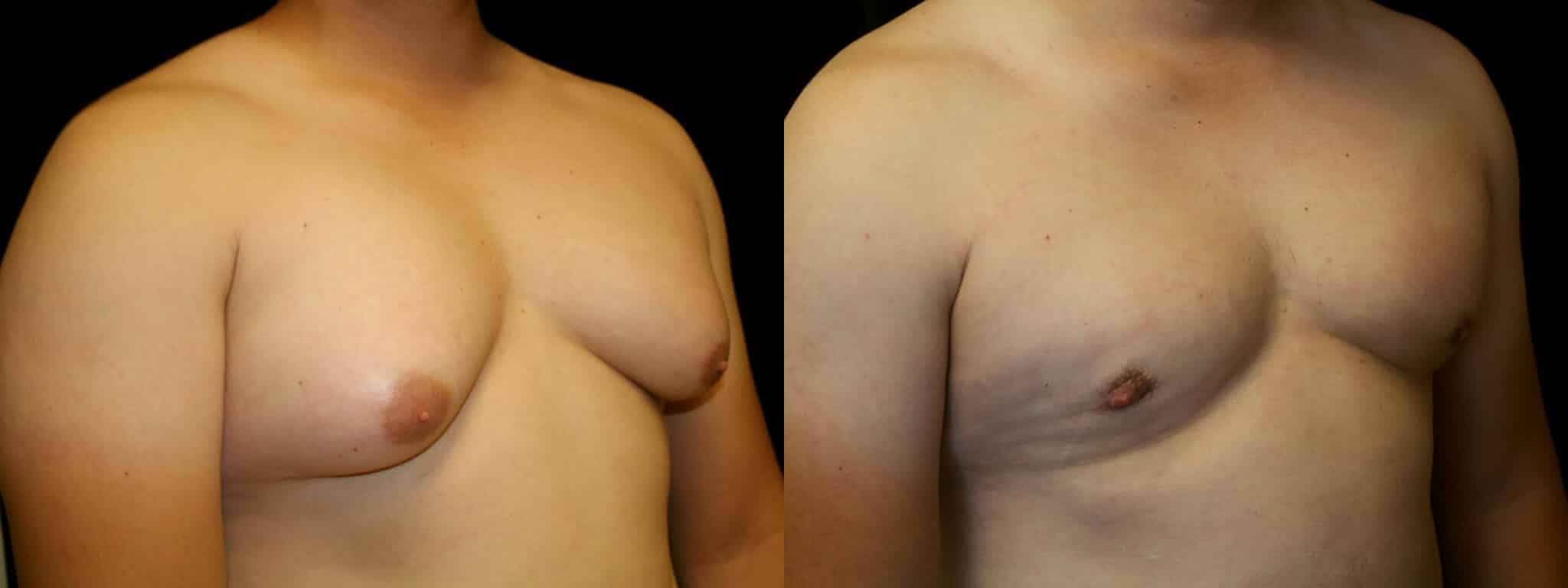 Gynecomastia Patient 13 Before & After Details