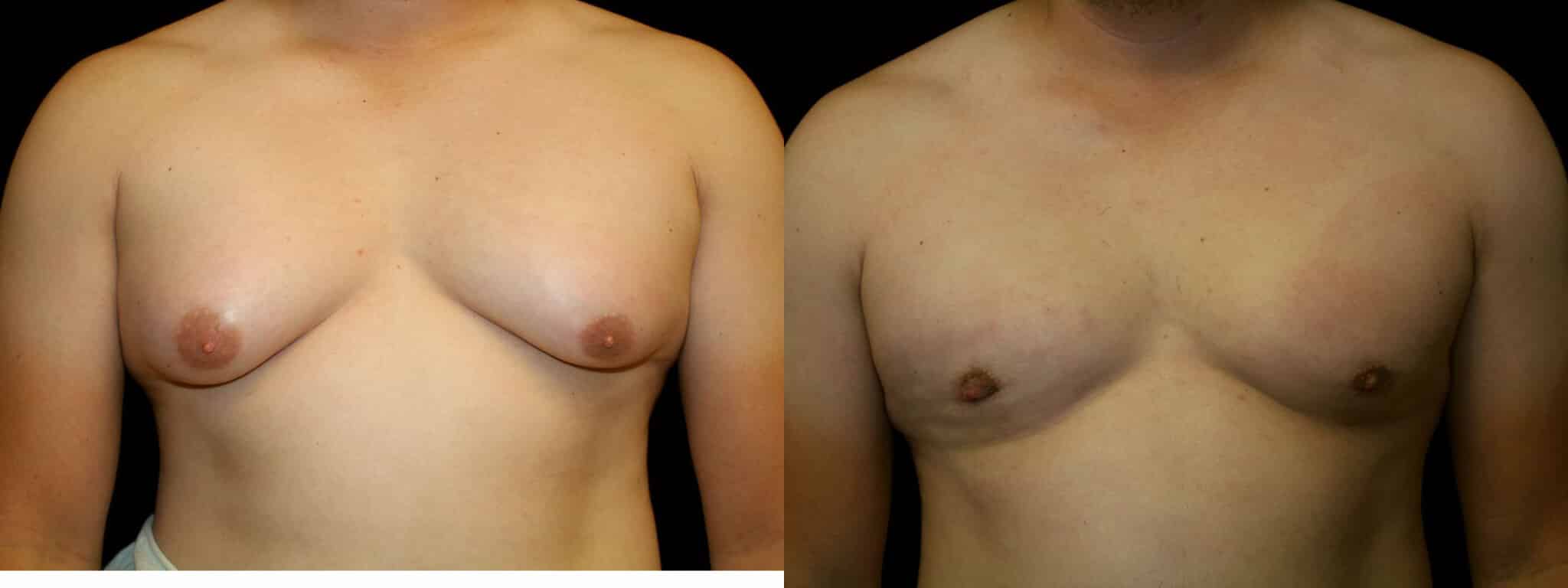 Gynecomastia Patient 13 Before & After