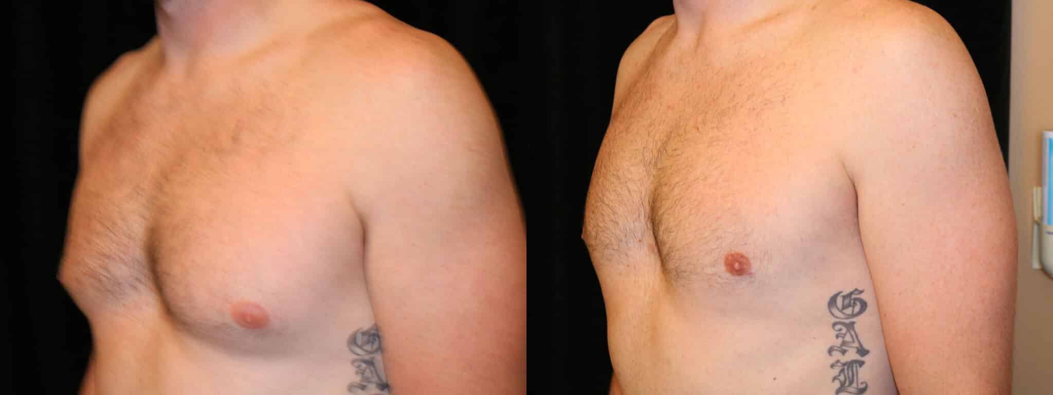 Gynecomastia Patient 19 Before & After Details