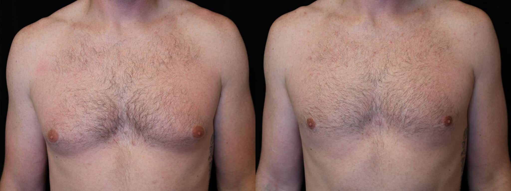 Gynecomastia Patient 19 Before & After