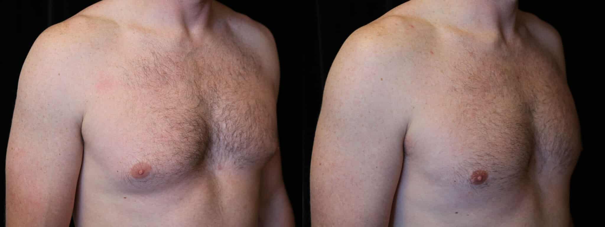 Gynecomastia Patient 19 Before & After Details