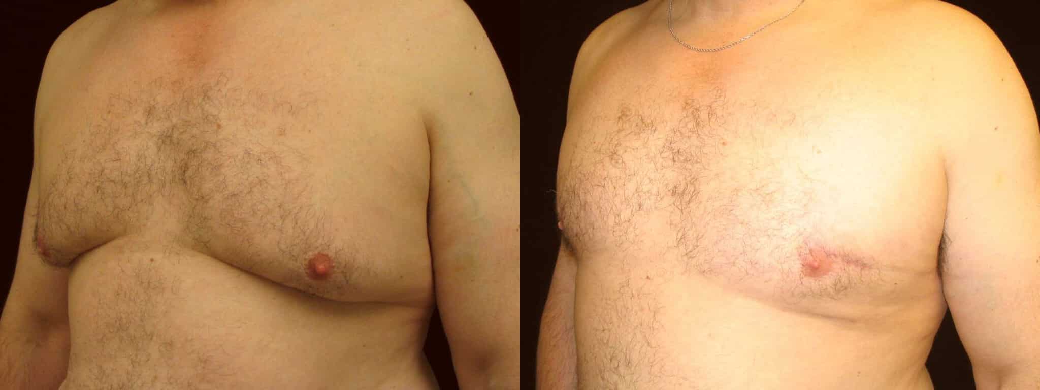 Gynecomastia Patient 4 Before & After Details