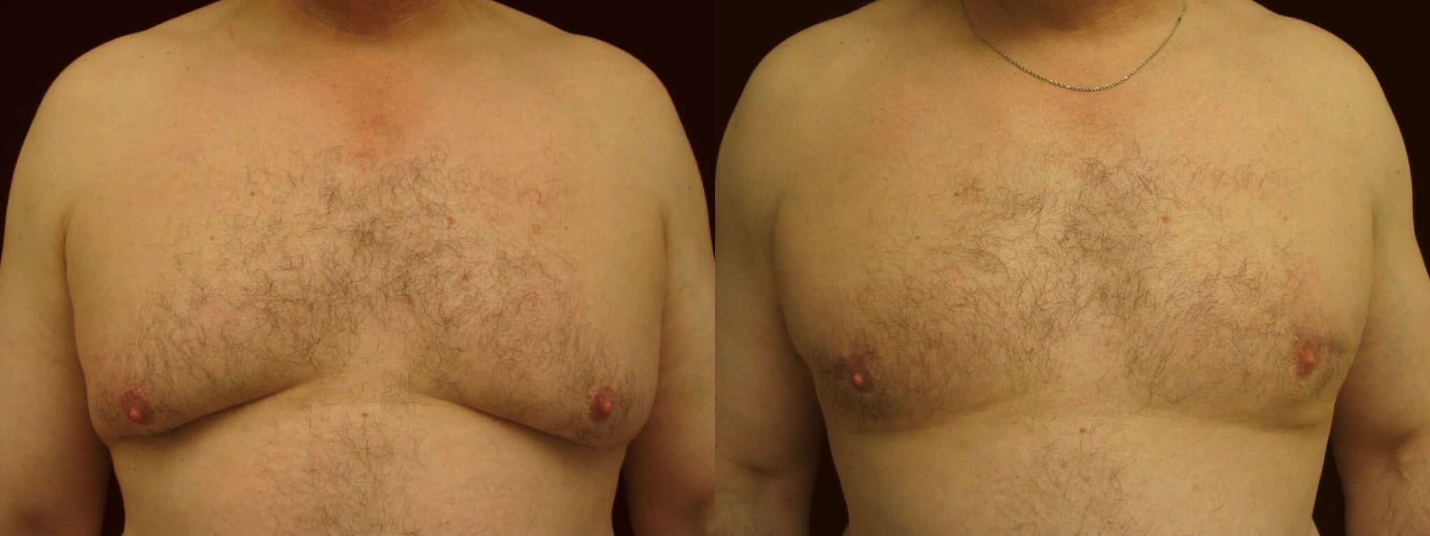 Gynecomastia Patient 4 Before & After