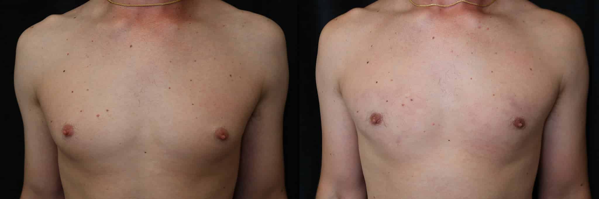 Gynecomastia Patient 17 Before & After