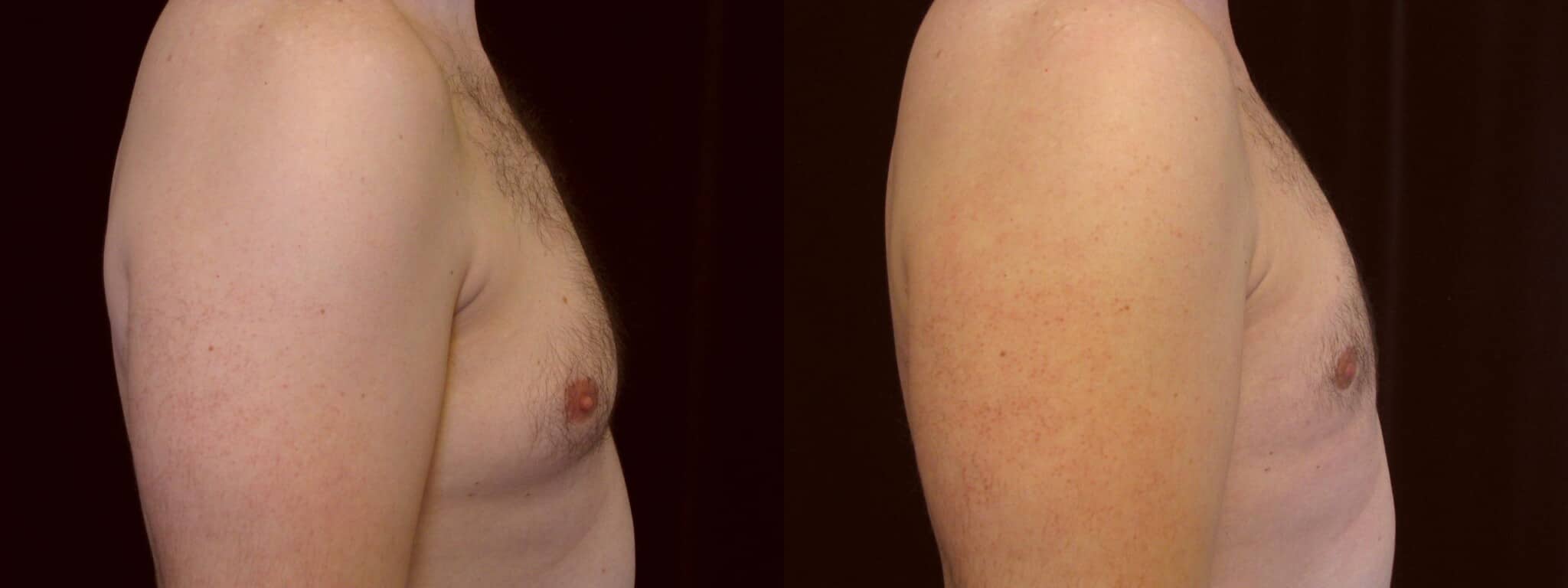 Gynecomastia Patient 15 Before & After Details