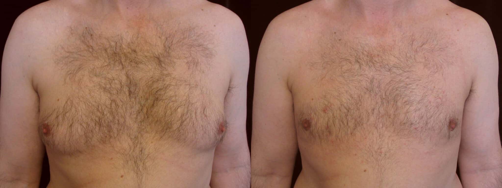 Gynecomastia Patient 15 Before & After