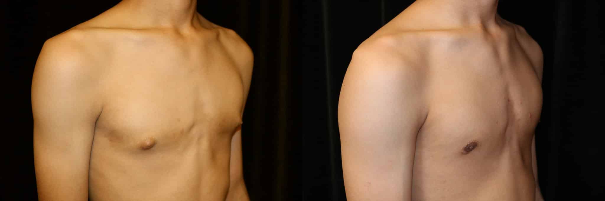 Gynecomastia Patient 3 Before & After Details