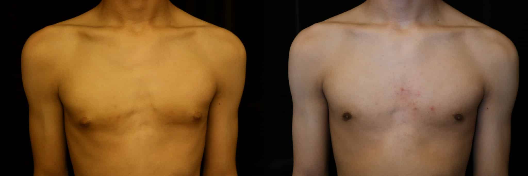 Gynecomastia Patient 3 Before & After