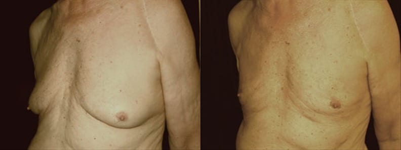 Gynecomastia Patient 15 Before & After Details