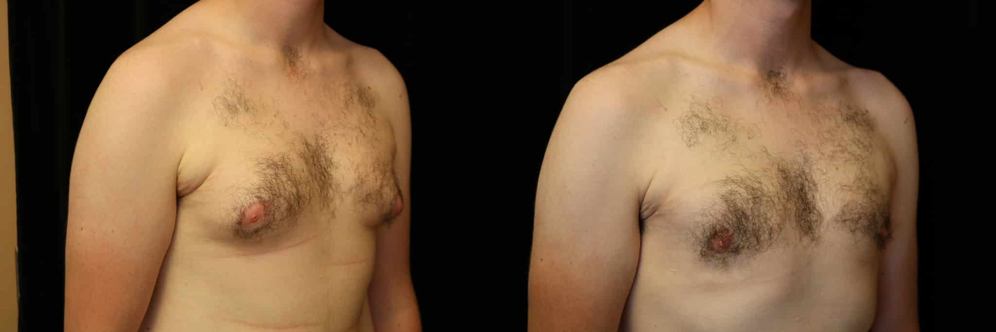 Gynecomastia Patient 21 Before & After Details