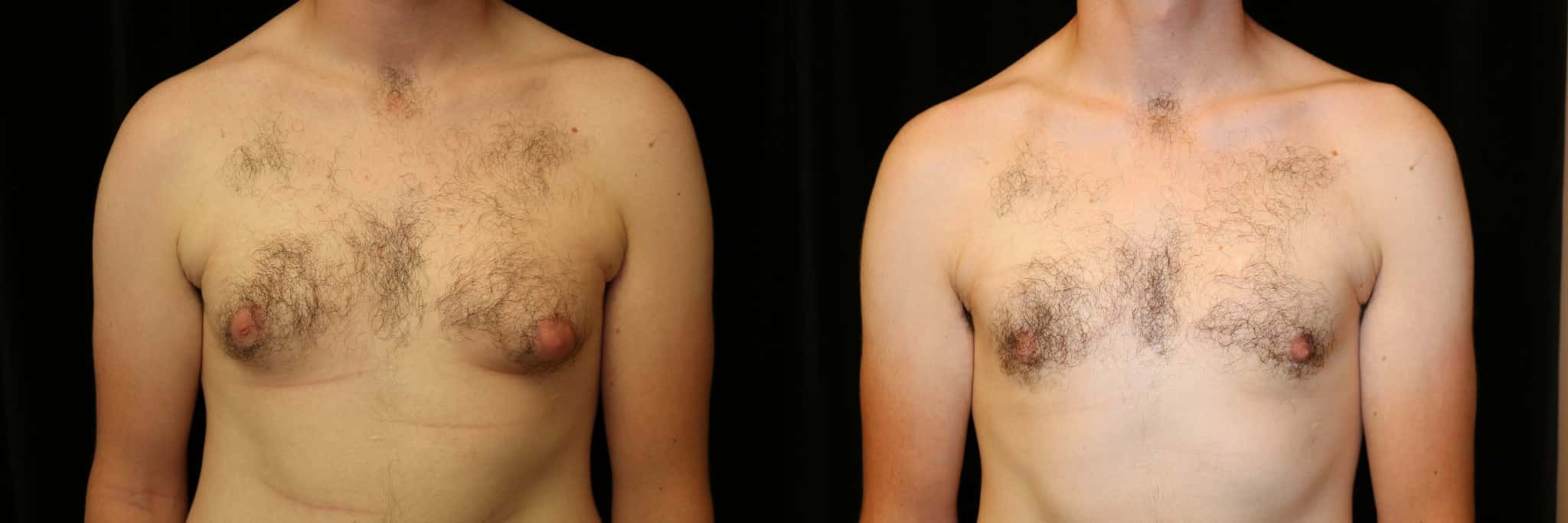 Gynecomastia Patient 21 Before & After