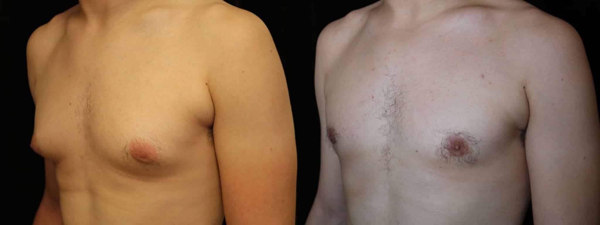 Gynecomastia Patient 17 Before & After Details