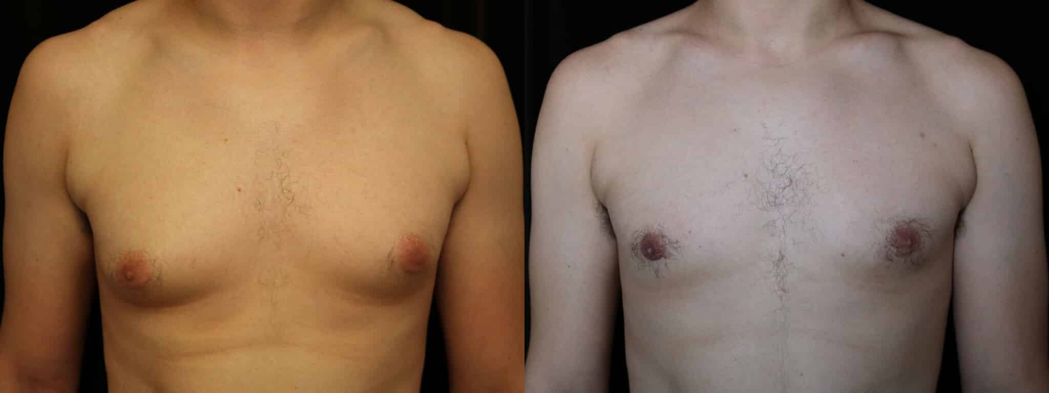 Gynecomastia Patient 17 Before & After