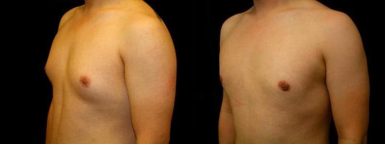 Gynecomastia Patient 19 Before & After Details